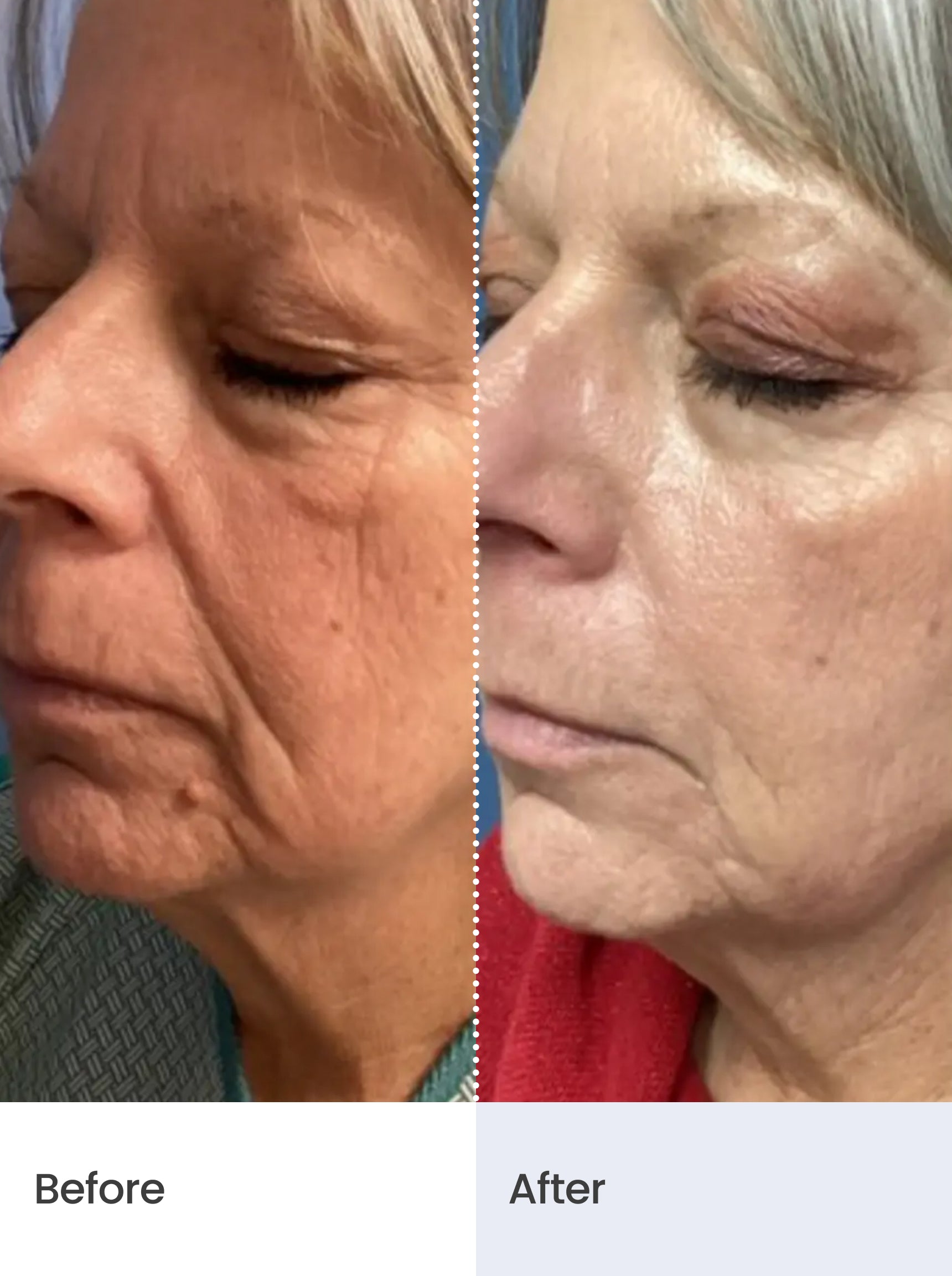 HYDRA-LIFT™ Anti-aging Day Cream