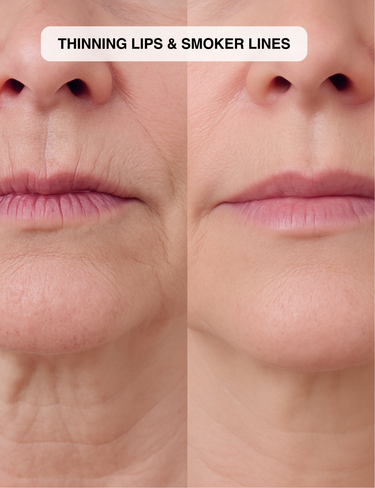 Micro-Infusion System 2.0