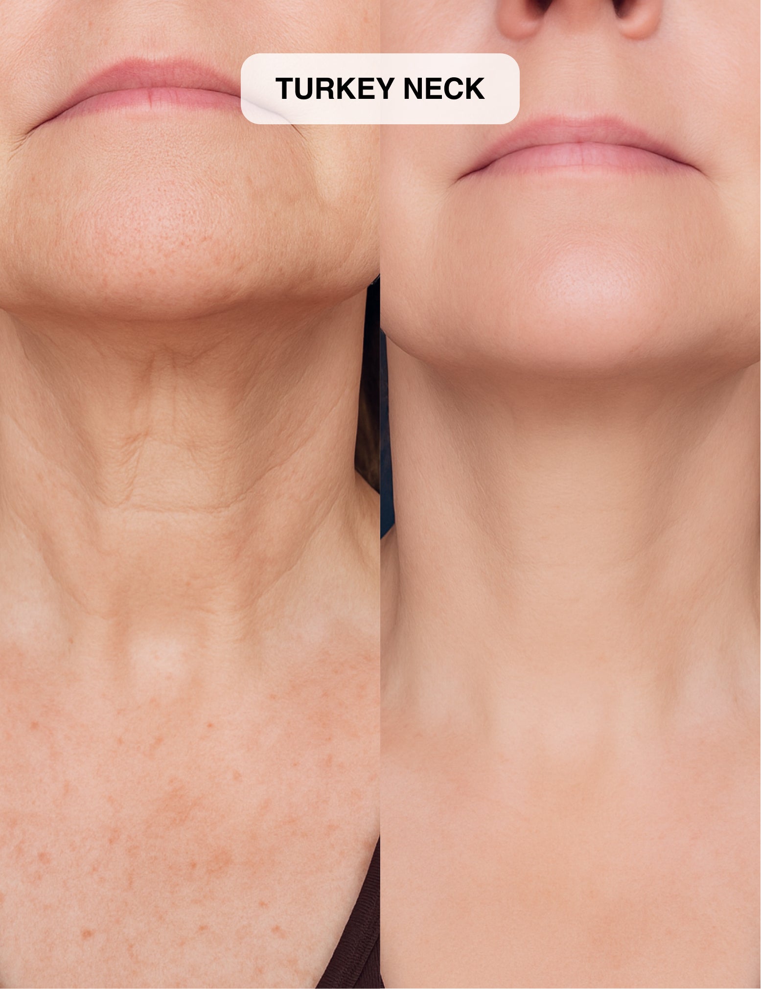 Micro-Infusion System 2.0