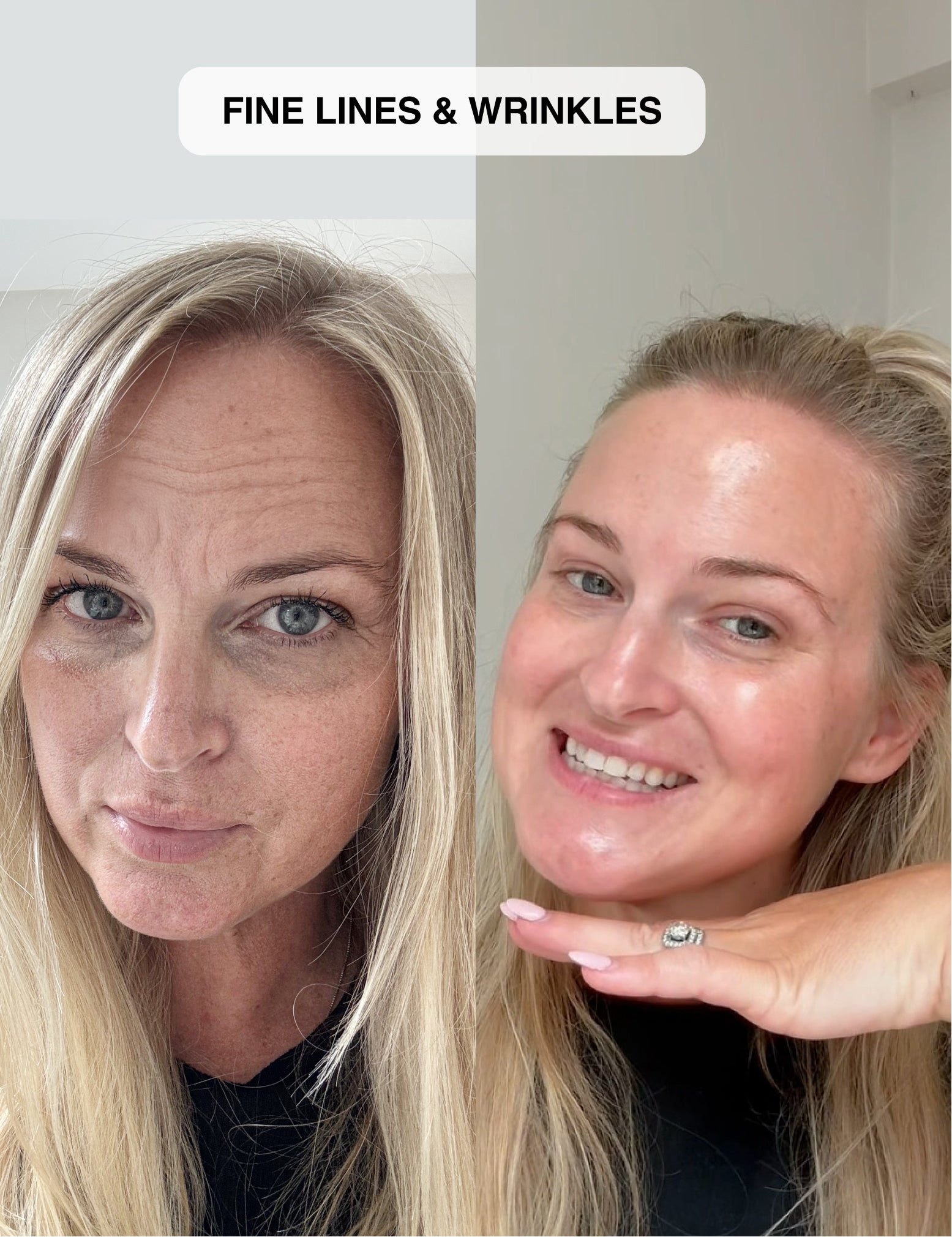 Micro-Infusion System 2.0