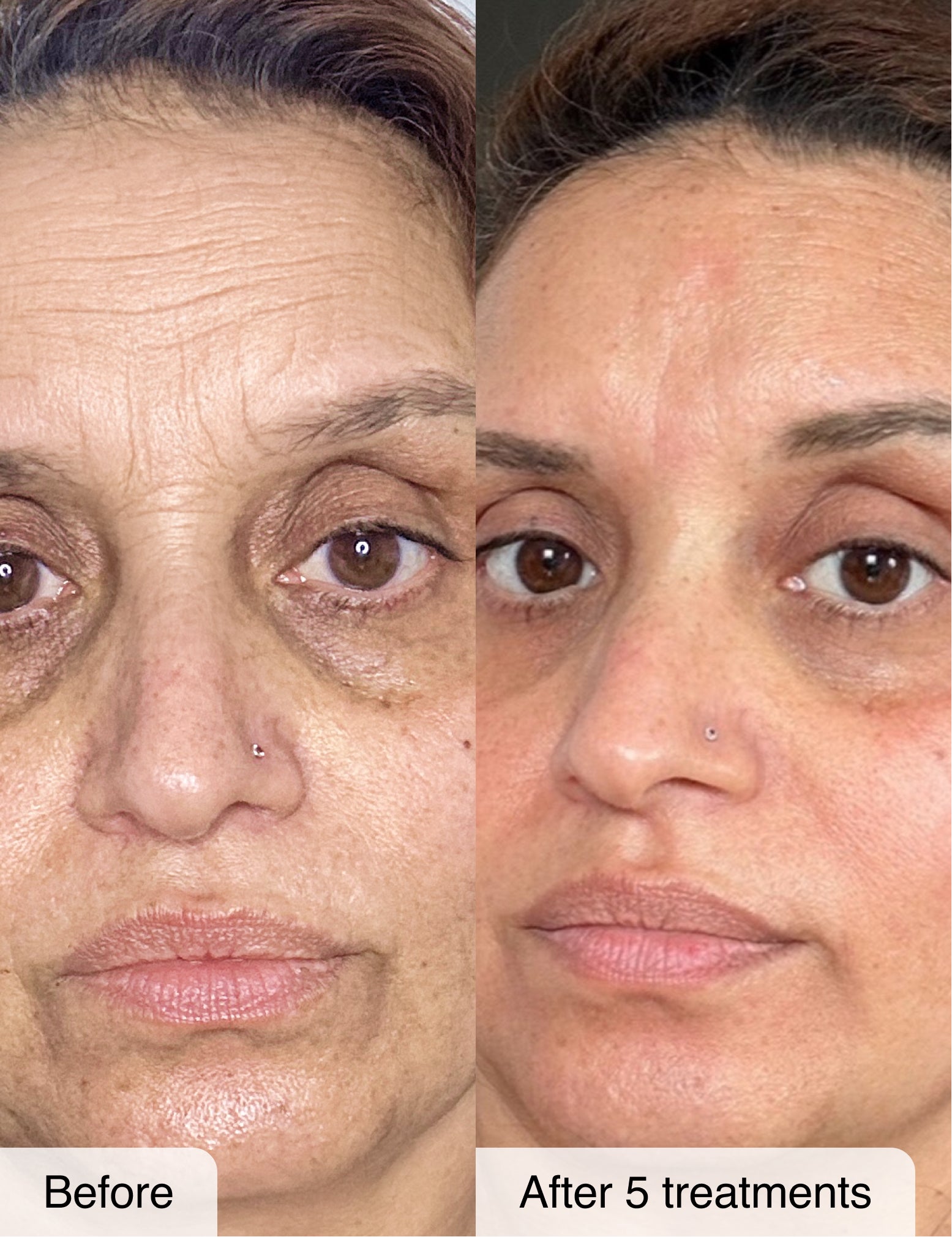 Micro-Infusion System 2.0