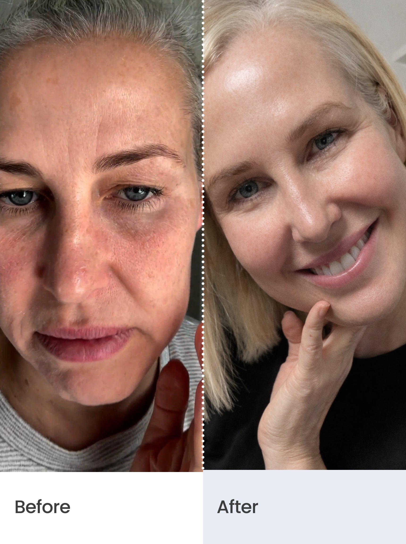 CLINICAL SKIN VOLUME FILLER SYSTEM