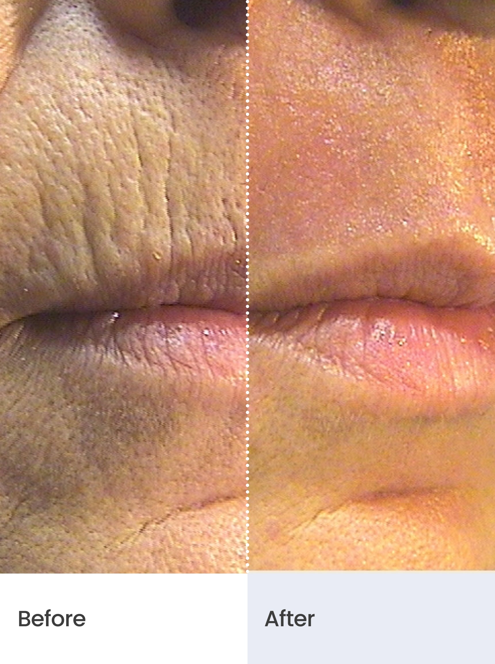 CLINICAL SKIN VOLUME FILLER SYSTEM