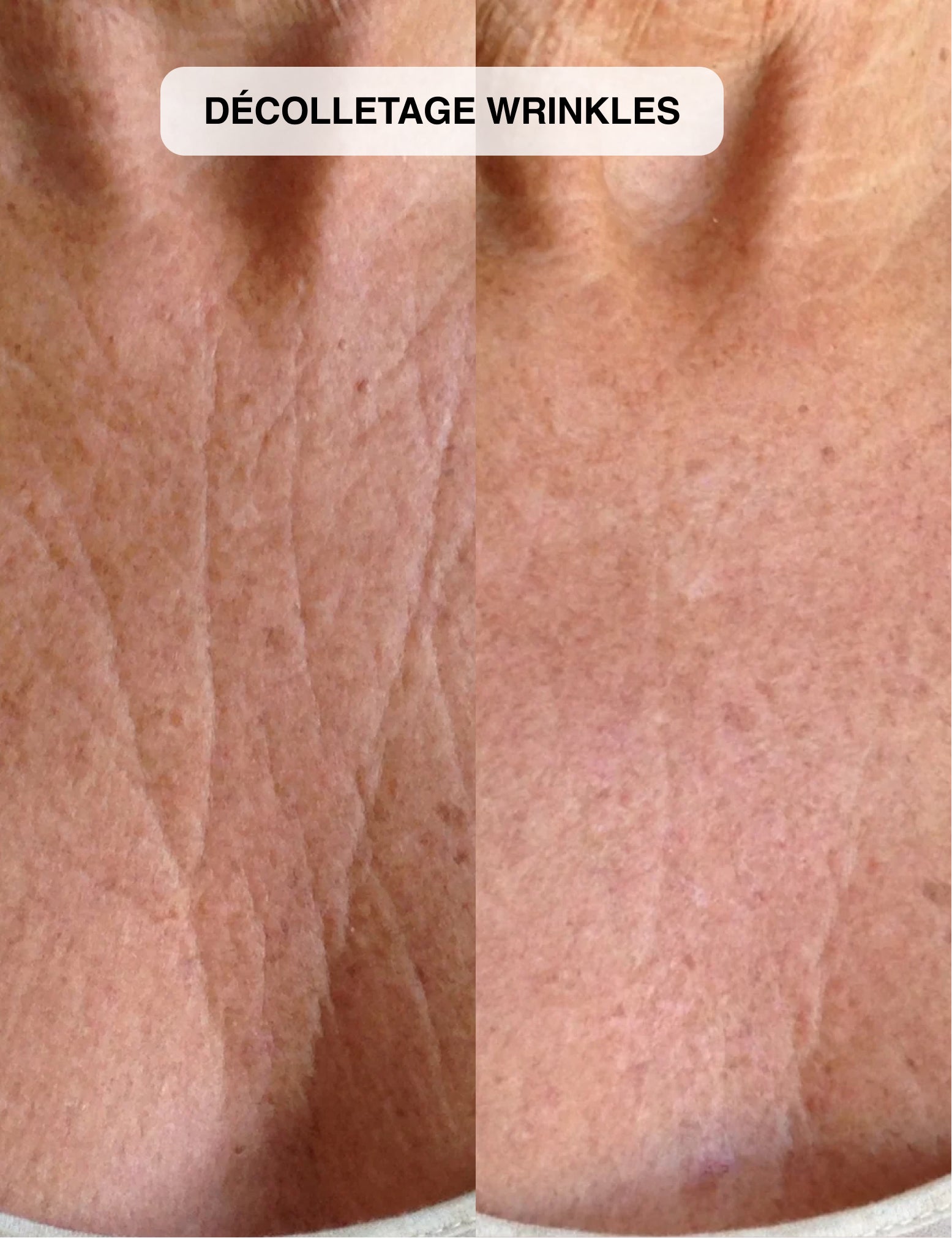 Micro-Infusion System 2.0