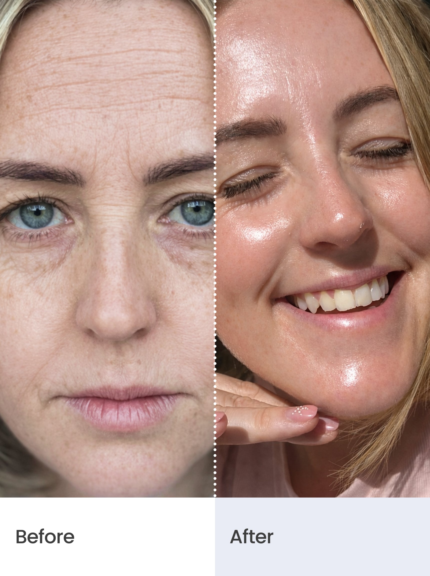 CLINICAL SKIN VOLUME FILLER SYSTEM