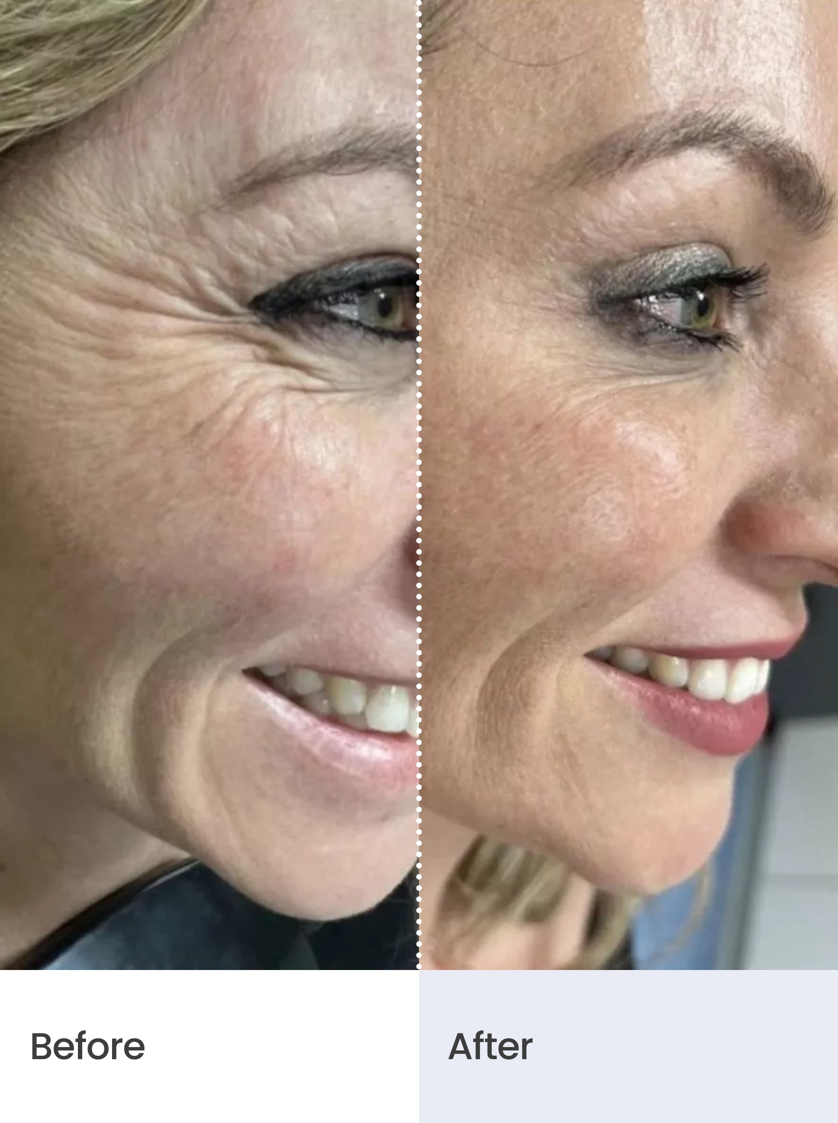 CLINICAL SKIN VOLUME FILLER SYSTEM